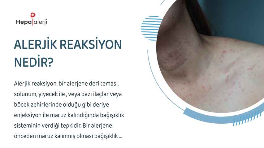 Alerjik reaksiyon nedir?